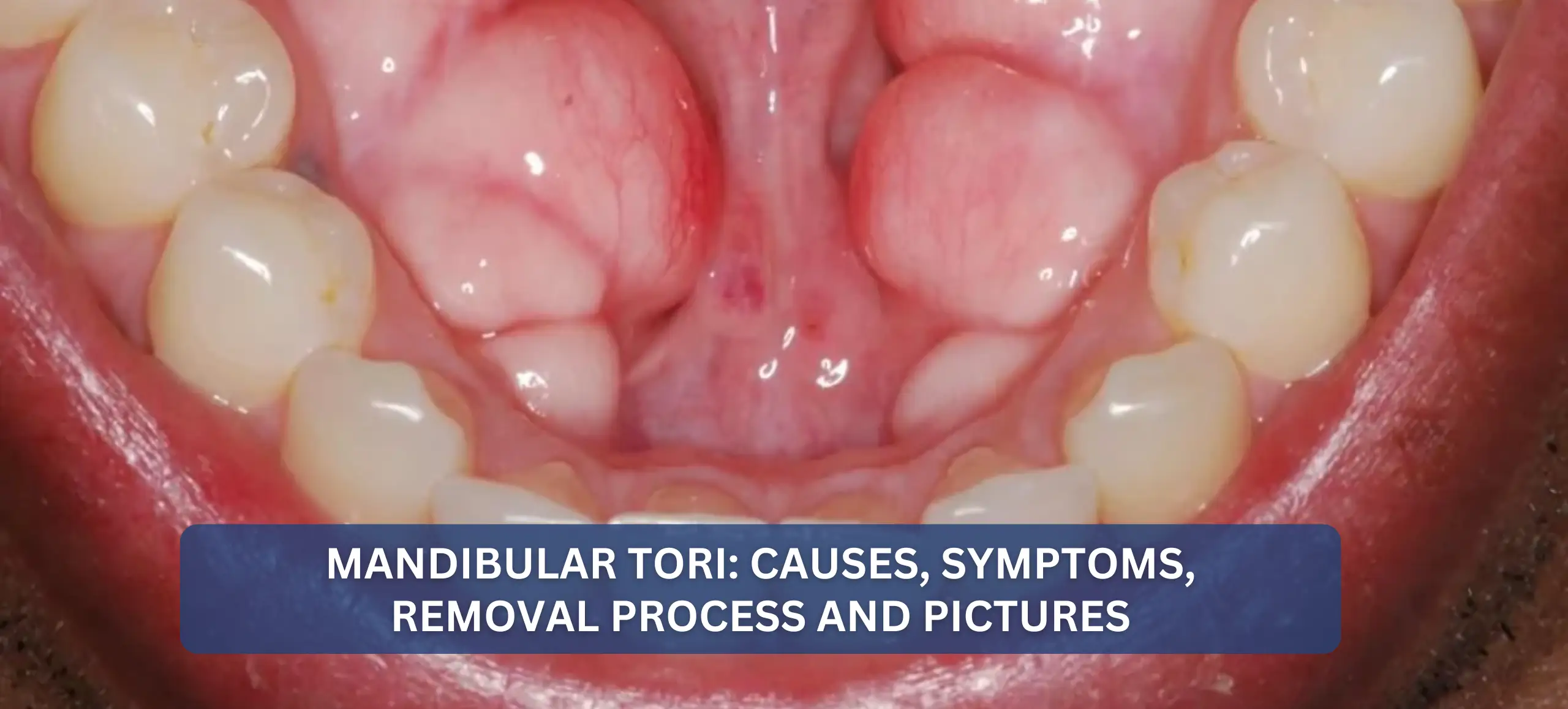 Mandibular-Tori-Causes-Symptoms-Removal-Process-and-Pictures