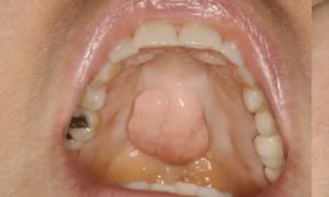 Mandibular-Tori-Images