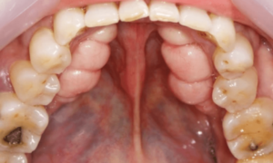 Mandibular-Tori-Photo