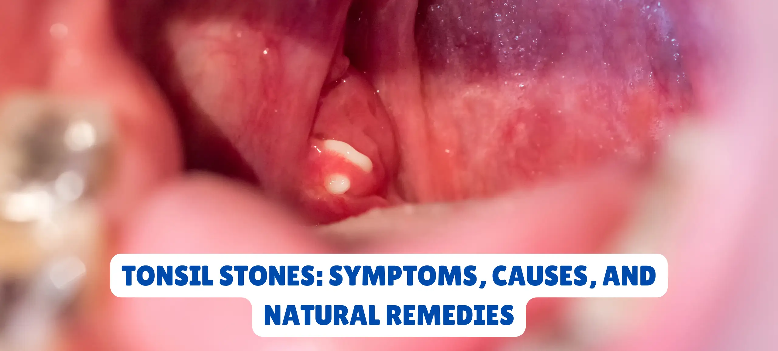 Tonsil Stones: Symptoms, Causes, and Natural Remedies