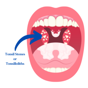 What Are Tonsil Stones or Tonsilloliths - Daily Dentists