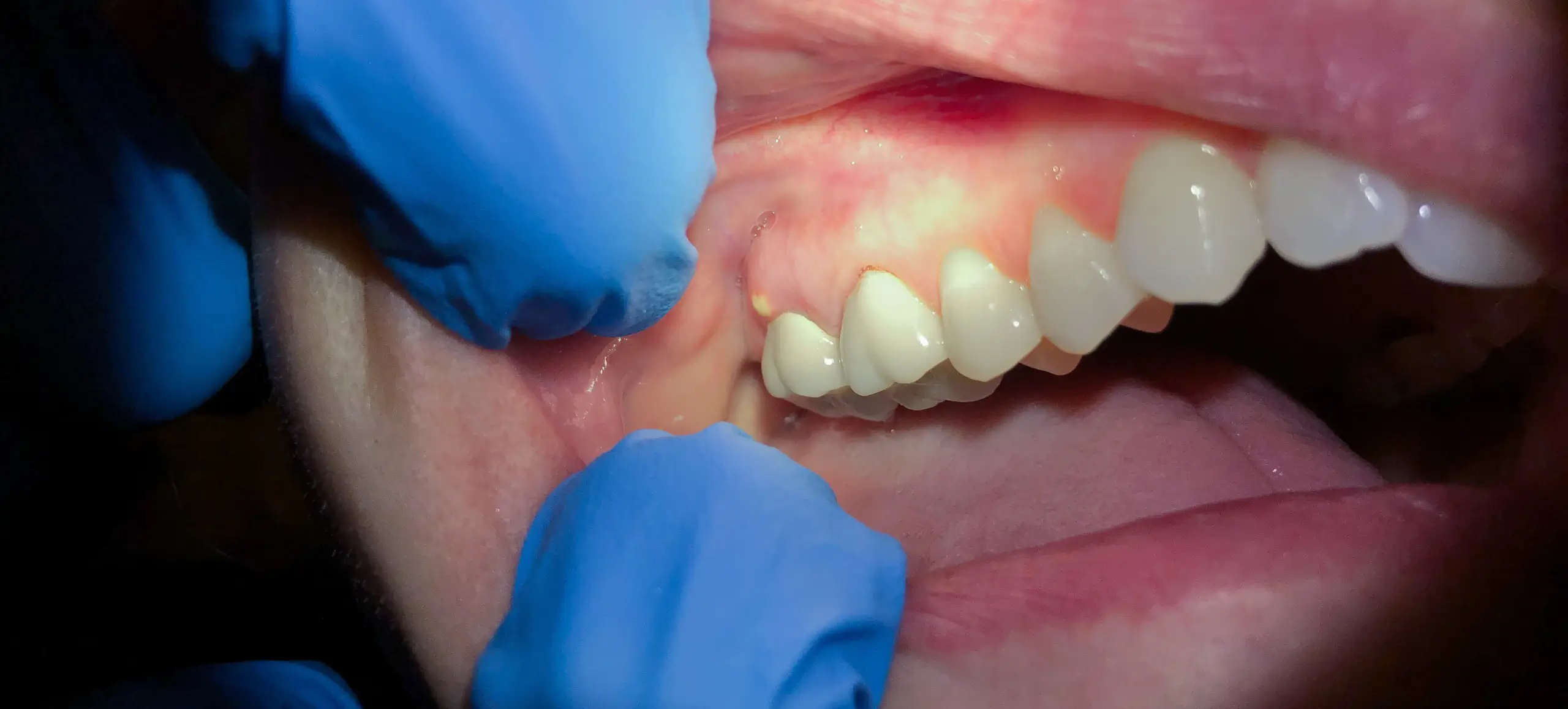 What Happens to the Abscess After Tooth Extraction