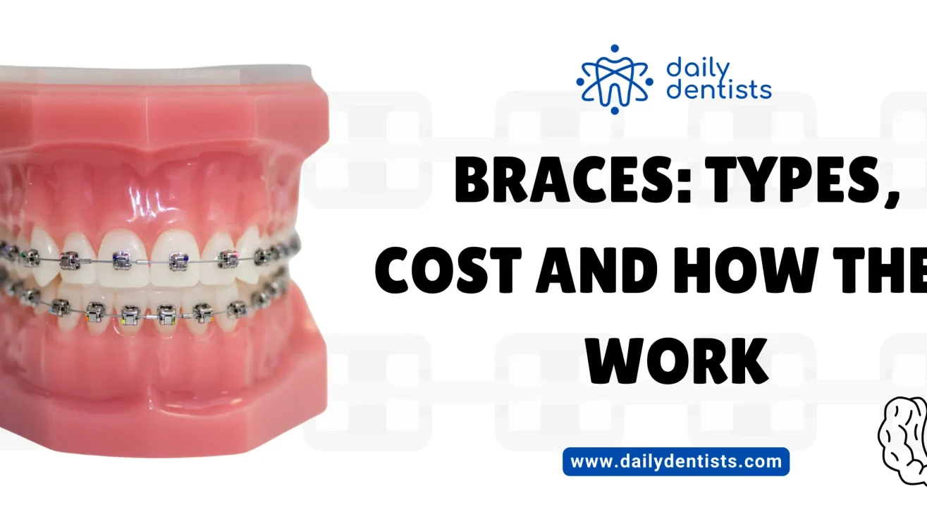 Braces: Types, Cost and How They Work