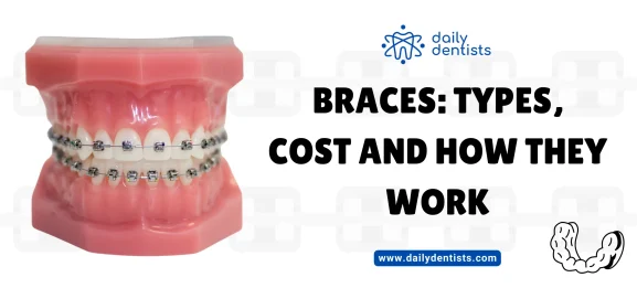 Braces-Types-Cost-and-How-They-Work