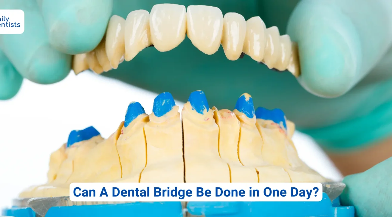 Can A Dental Bridge Be Done In One Day?