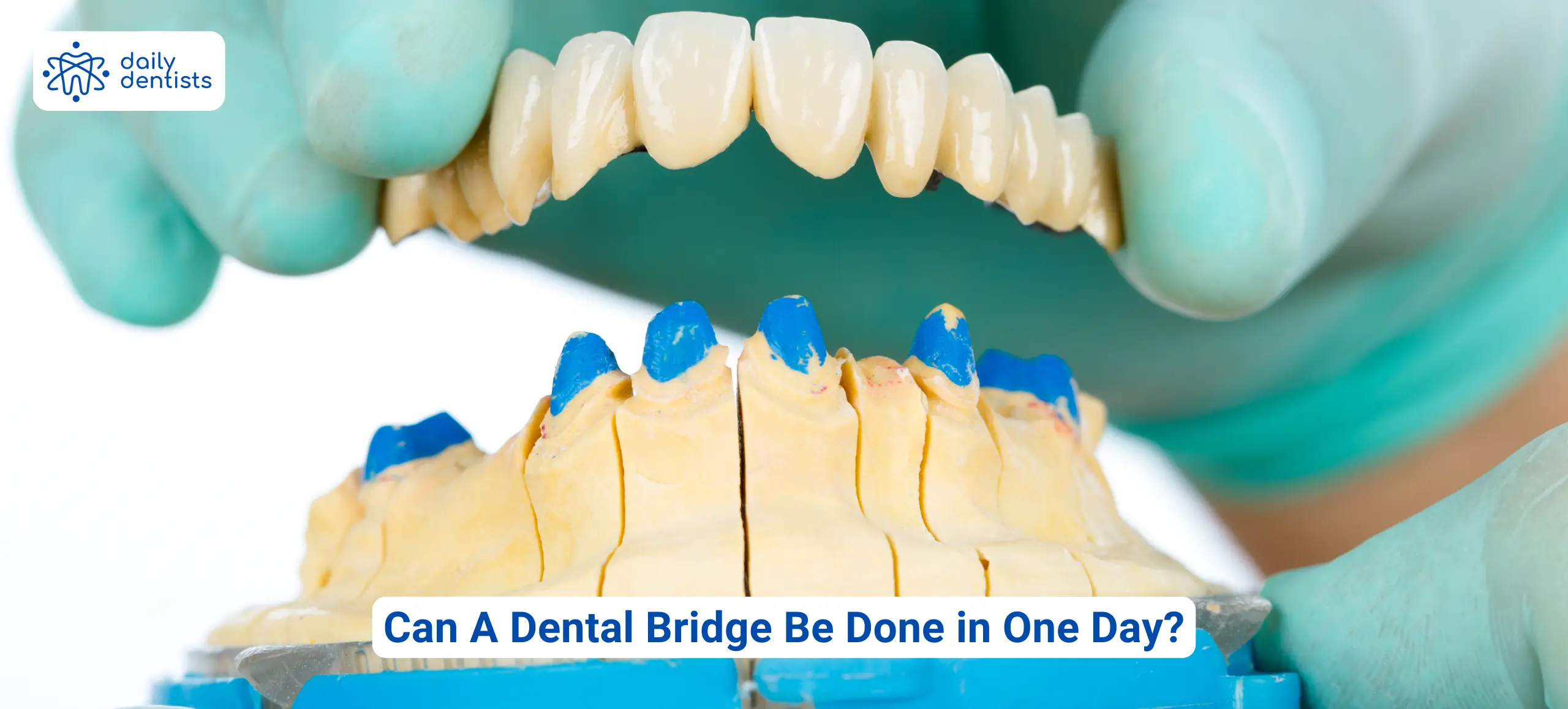 Can A Dental Bridge Be Done In One Day?