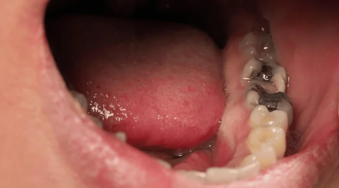 Is A Black Tooth An Emergency?