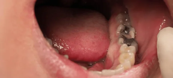 Is-a-Black-Tooth-an-Emergency