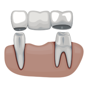 What-is-the-Same-Day-Dental-Bridge