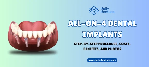 All-On-4-Dental-Implants-Step-by-Step-Procedure-Costs-Benefits-and-Photos