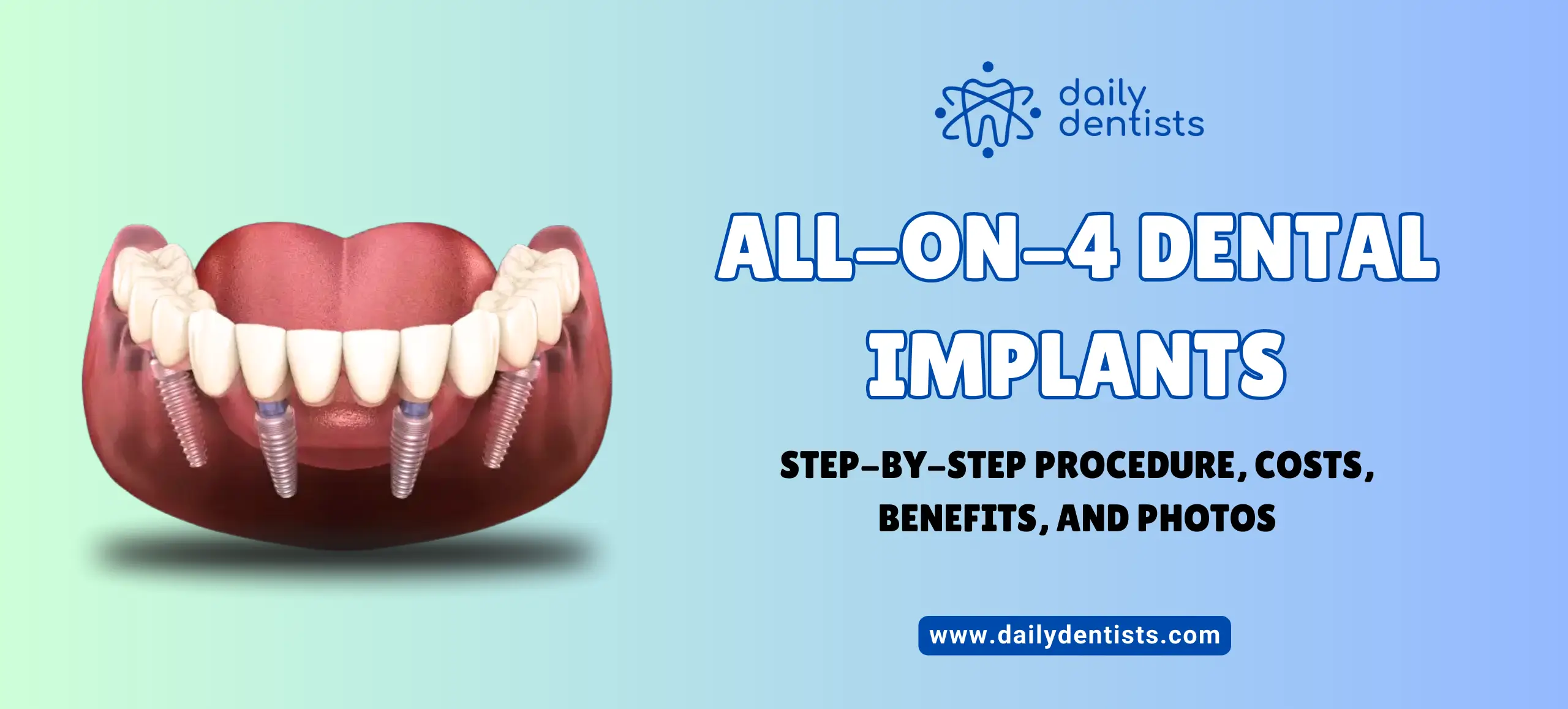 All-On-4 Dental Implants: Step-by-Step Procedure, Costs, Benefits, and Photos