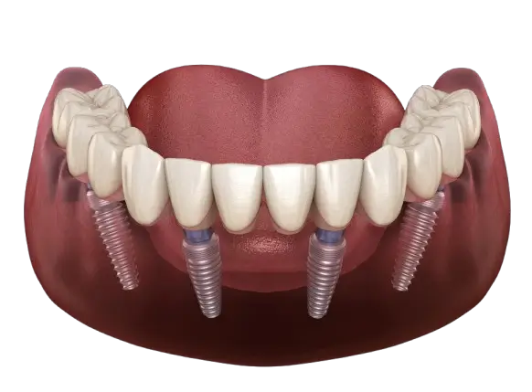 what is all on four dental implants