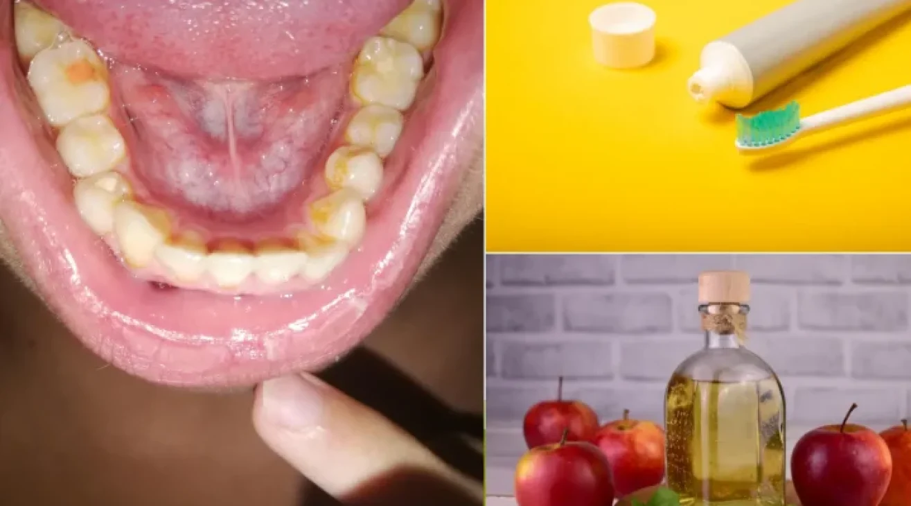 How To Remove Coffee Stains From Teeth Naturally