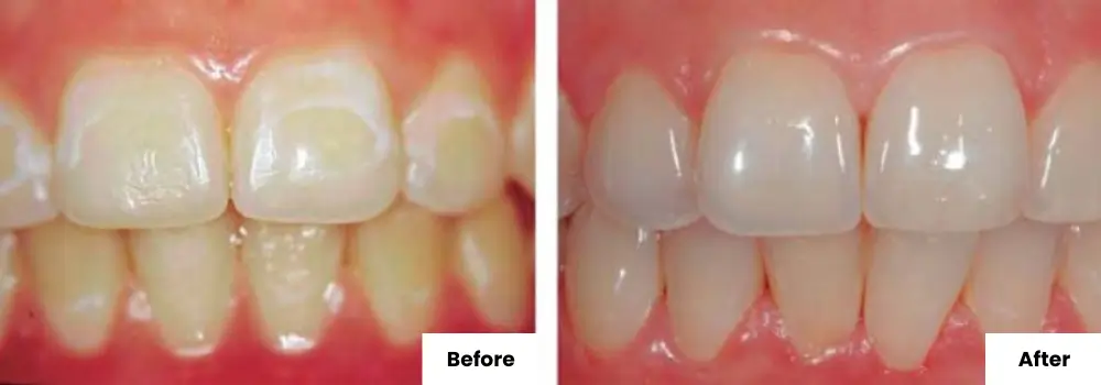 Teeth Remineralization Before and After