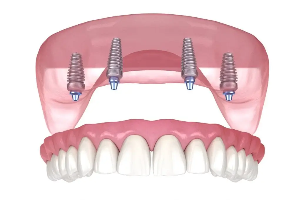 all-on-4-dental-implants close up