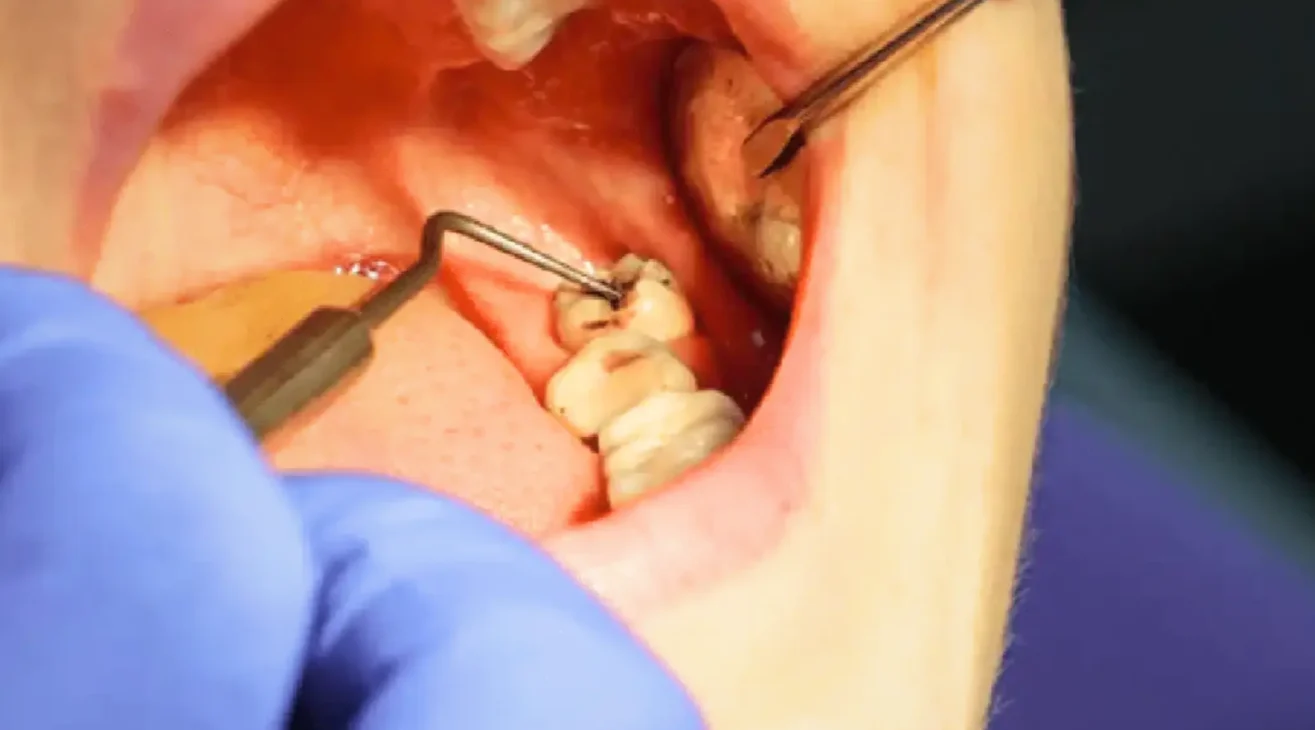 What Should You Do If Your Wisdom Tooth Has a Cavity? Daily Dentists’ Take