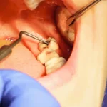 What Should You Do If Your Wisdom Tooth Has a Cavity