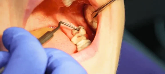 What Should You Do If Your Wisdom Tooth Has a Cavity?
