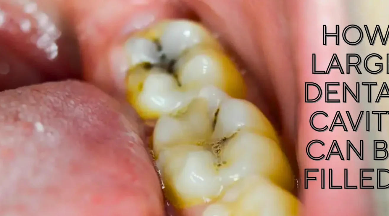 How Large Dental Cavity Can Be Filled?