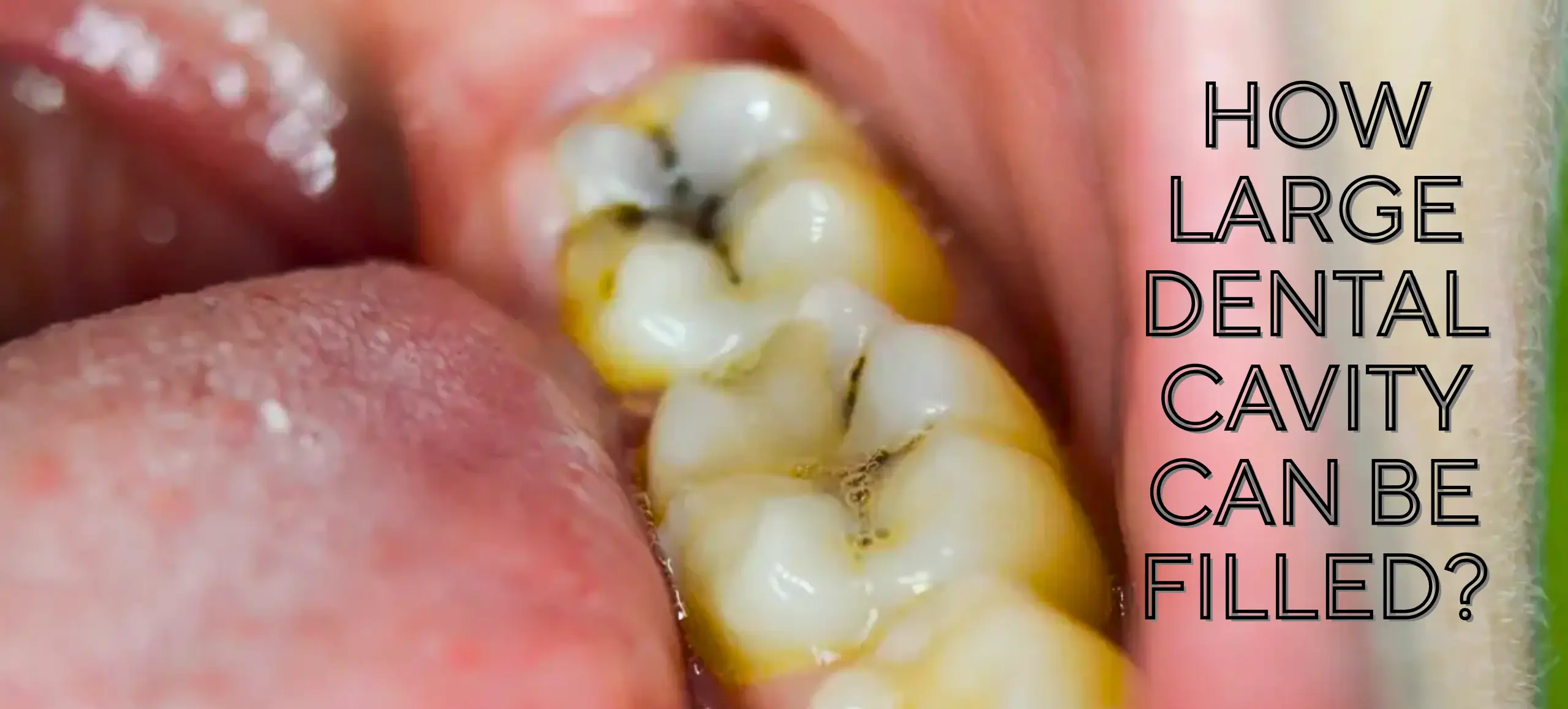 How Large Dental Cavity Can Be Filled?