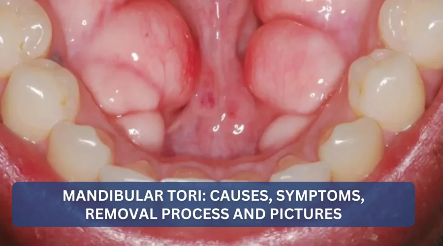 Mandibular Tori: Causes, Symptoms, Removal Process and Pictures