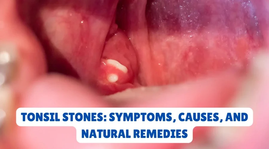 Tonsil Stones: Symptoms, Causes, and Natural Remedies