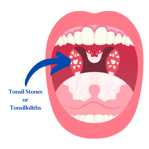 What-Are-Tonsil-Stones-or-Tonsilloliths