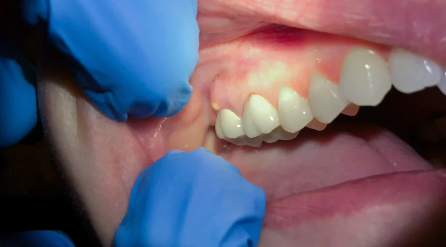 What Happens to the Abscess After Tooth Extraction