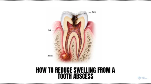 How to Reduce Swelling from a Tooth Abscess